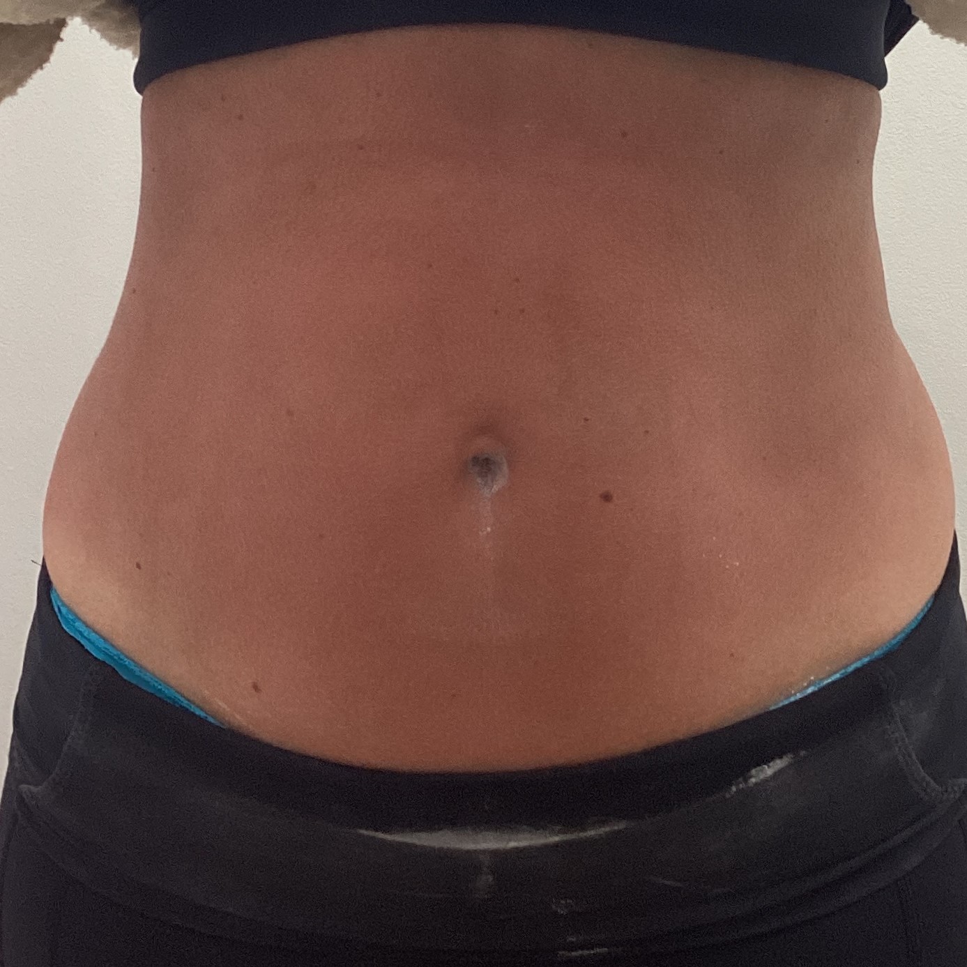 Cryo Slimming After